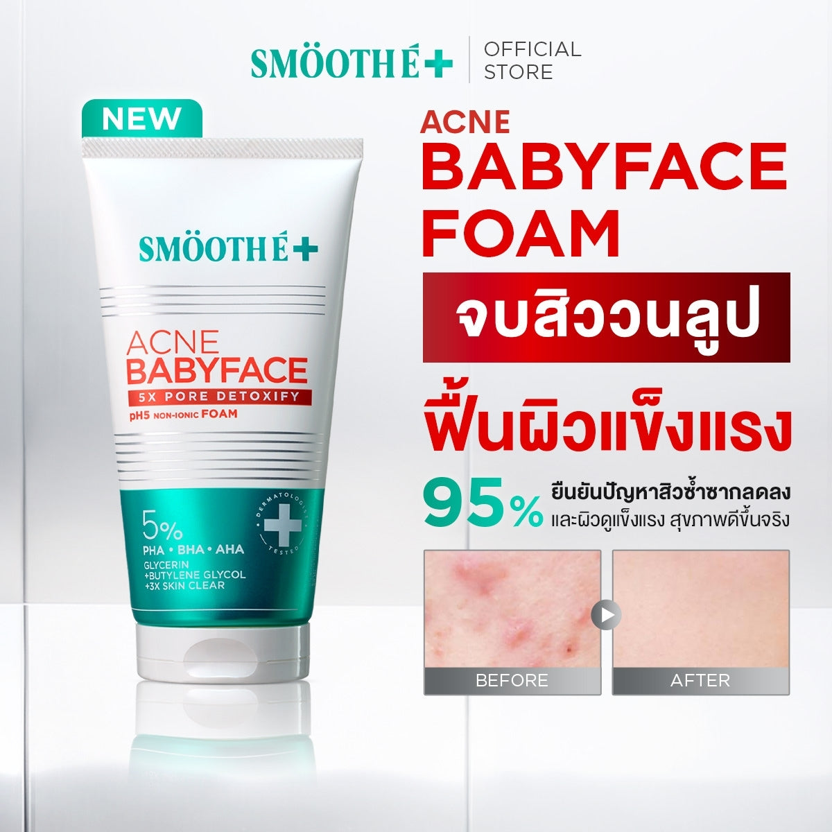 [Pre-Order] SMOOTHE BABYFACE ACNE-5 DETOXIFY NON-IONIC FOAM